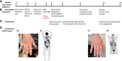 Intravenous immunoglobulin is safe and effective in controlling pre-existing paraneoplastic neuromuscular diseases in cancer patients treated with immune checkpoint inhibitors: two case reports and literature review